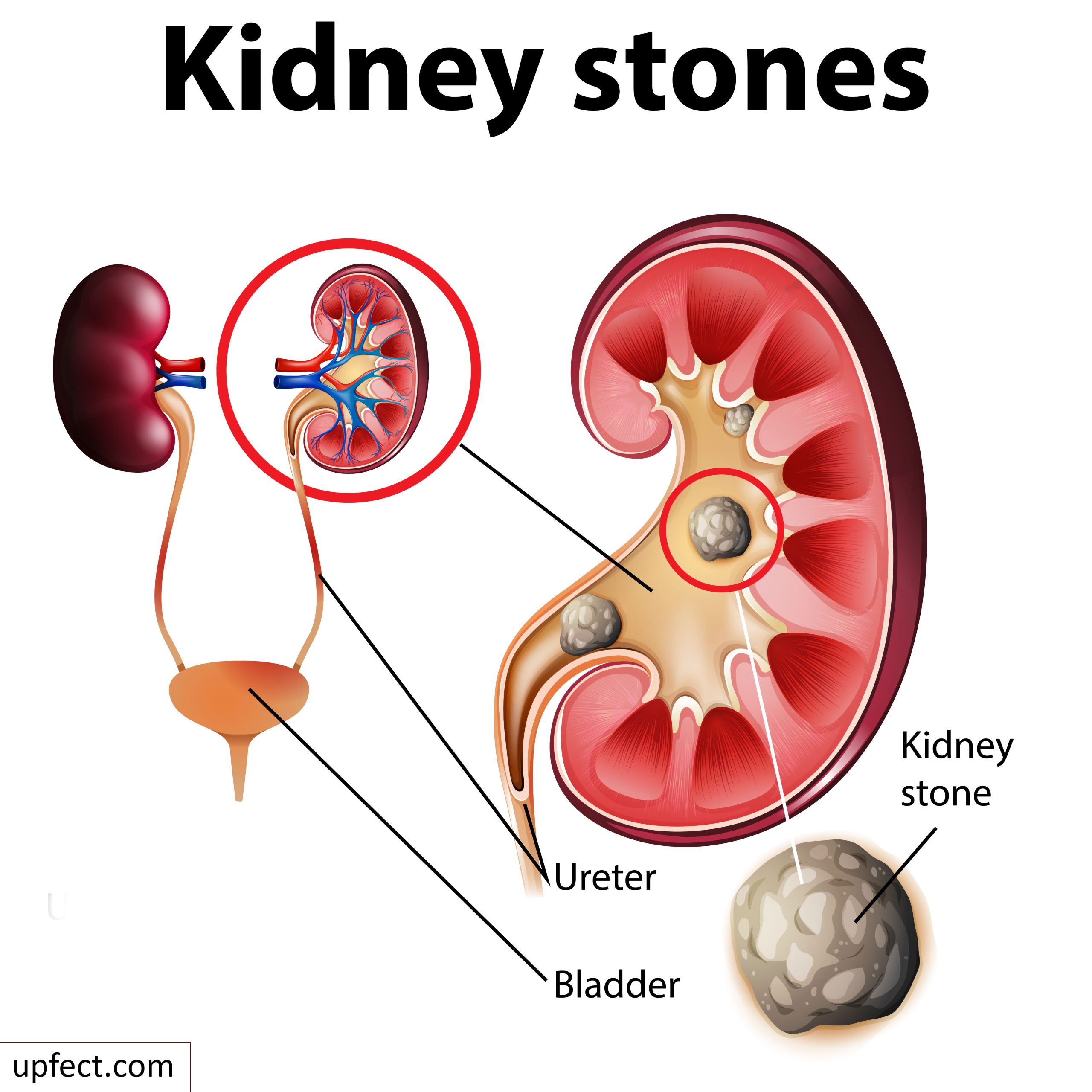 Kidney stone prevention